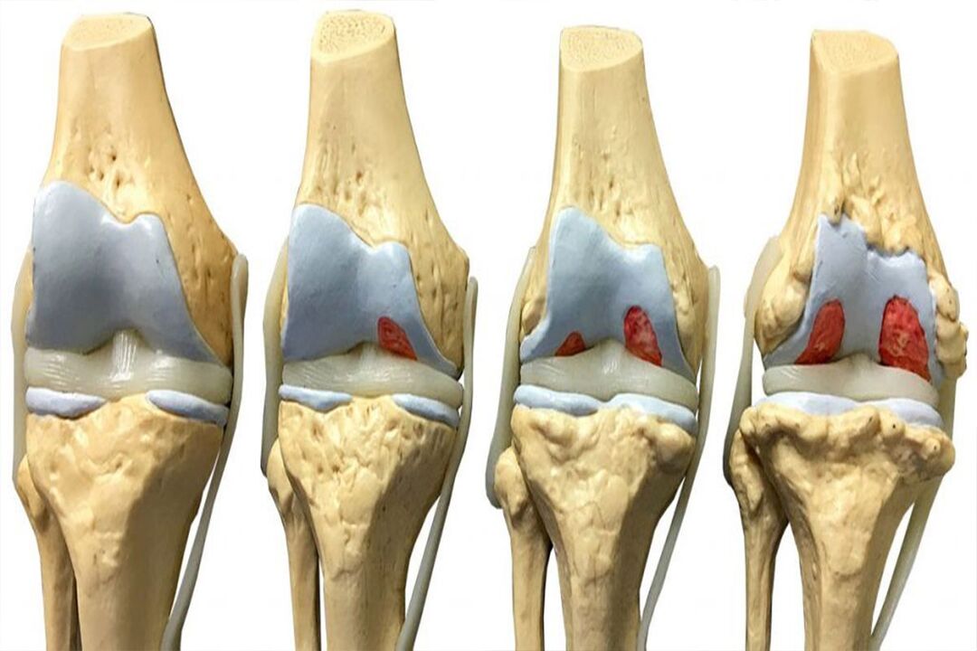 Stages of development of arthrosis