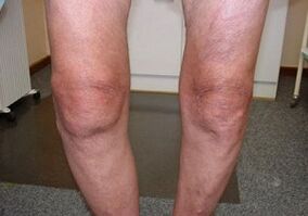 How to treat arthrosis of the knee joint
