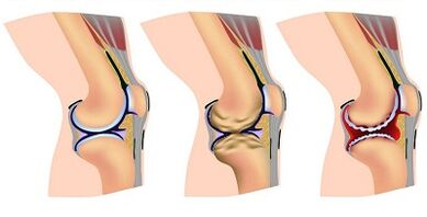 Stages of development of knee joint arthrosis